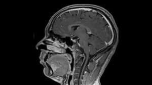 Magnetresonanztomographie-Kopf